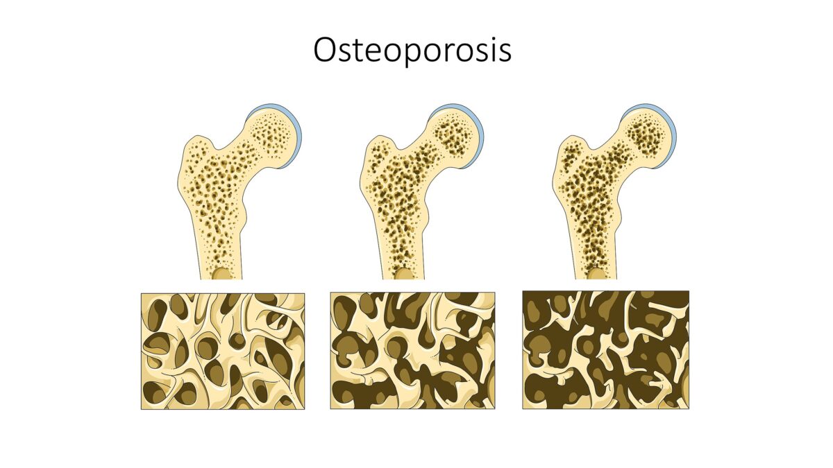 2560px-Osteoporosis-1200x675.jpg